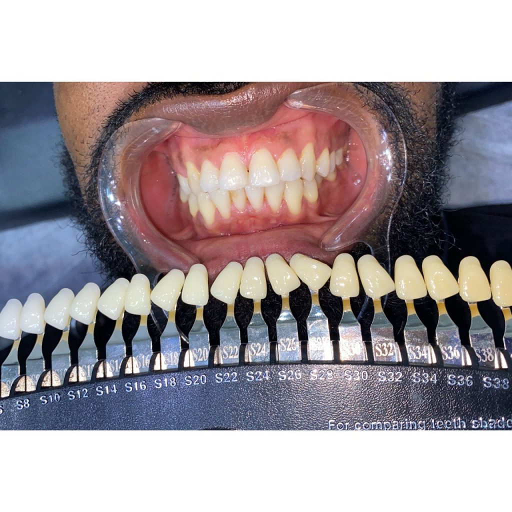 Nollywood Actor Diamond Okechi Sweet Smile After Teeth Whitening at Imani Aesthetic & Laser Clinic Lagos Nigeria