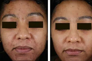 Imani Aesthetic and Laser Treatment. Best laser skin treatments clinic in lagos and abuja